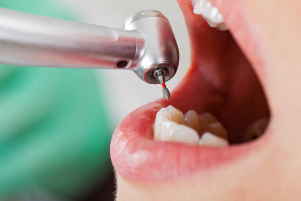 Best Emergency Wisdom Teeth Removal in Brookneal, VA